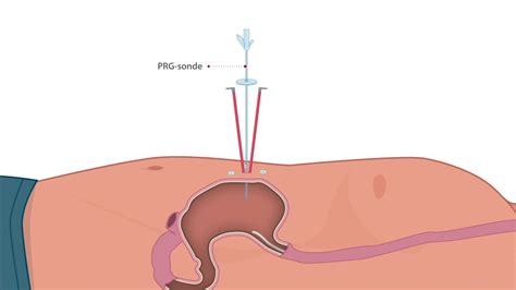 fakboi.prg|verschil peg en prg.